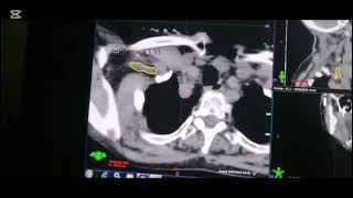 Brachial Plexus Contouring