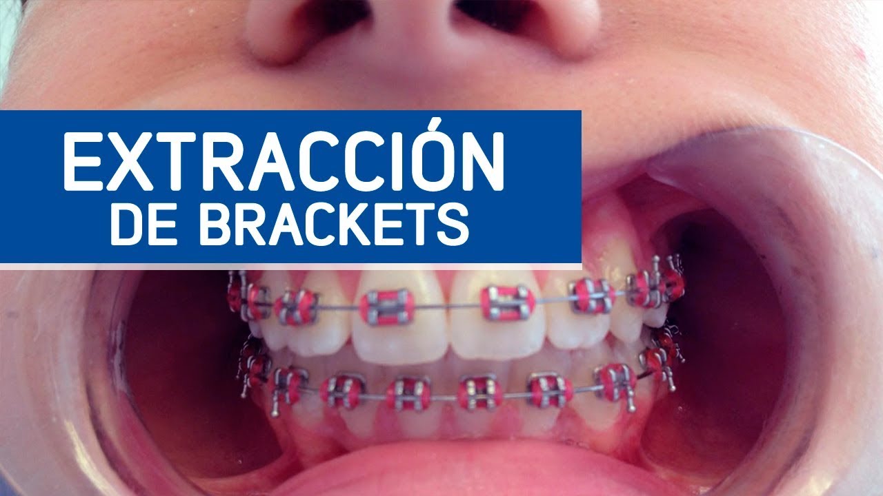 Resumen de 16+ artículos como se quitan los brackets [actualizado Resumen de 16+ artículos como se quitan los brackets [actualizado
