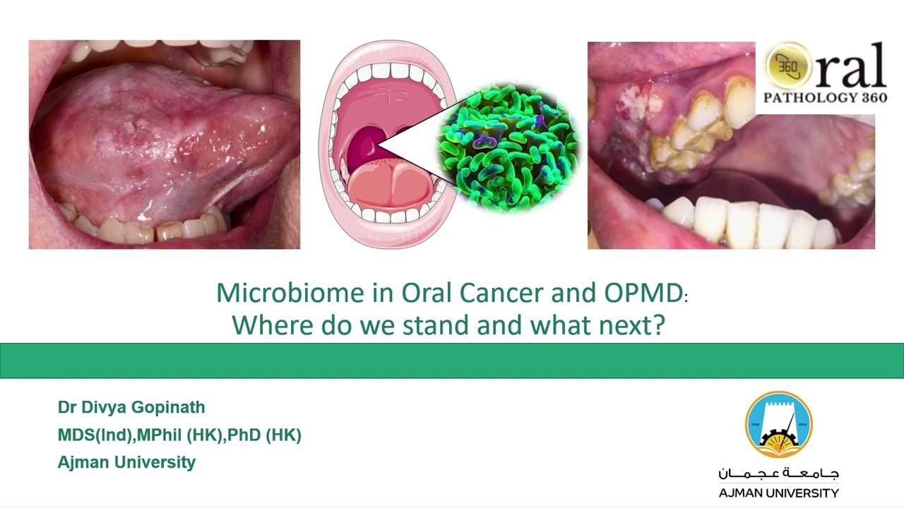 Что нам известно о микробиоме полости рта при раке полости рта?
