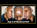 Skincare vlog day 4 of my chemical peel for hyperpigmentation  clearer skin  mikara reid