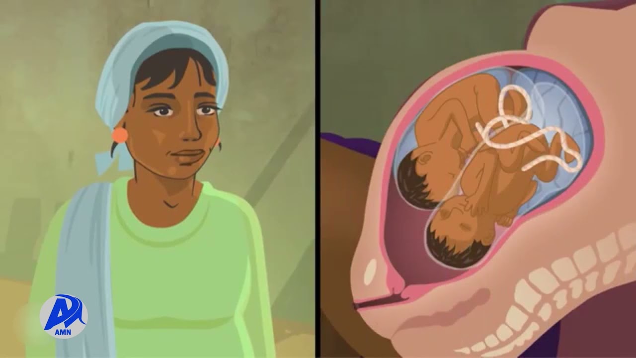 ከወሊድ በኋላ የሚከሰት የደም መፍሰስ (ጥር 3/2014 ዓ.ም)