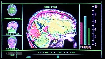 Rocky V (1990) - Brain Damage Cavum Septum
