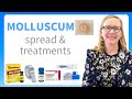 Molluscum FAQ about the spread and treatment from a pediatric dermatologist in 2022