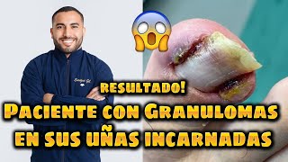 resultado | Pacientes no visito presentando uñas incarnadas con Granulomas