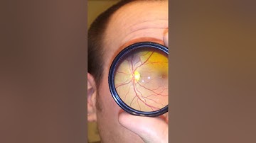 Cell Phone Fundus Video