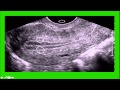 GYN Ultrasound