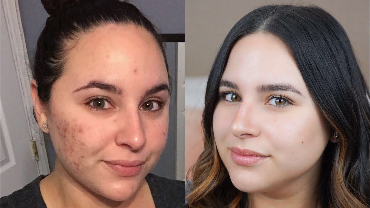How to Get Clear Skin | My Acne Story - YouTube