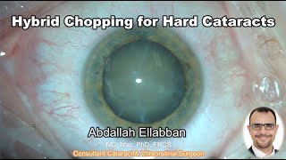 Hybrid Chopping for Hard Cataracts - Top Tips for Better Outcomes