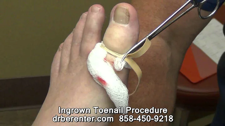 Ingrown Toenail San Diego