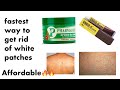 How To Get Rid of WHITE PATCHES|| SKIN WHITE SPOT| #skincare #bbtaffairs #skinpatches  #whitepatches