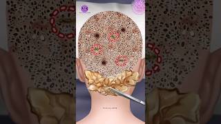 ASMR Giant hardened flakes dandruff removal at hairline | Scalp treatment animation | #asmr #viral screenshot 5