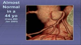 Coronary CTA: Soft Plaque Detection Part 1 screenshot 1