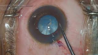 Mini Rhexis in Intumescent Cataract