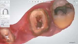 (German) 3Shape DentalSystem - Post and core on TRIOS case