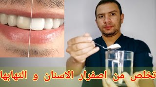 5 طزق تخلصك من الاسنان الصفراء و البنيه و التهابات اللثه خلال ايام