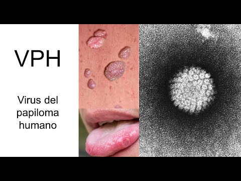 Conoce el VPH - Diagnóstico, Tratamiento y Prevención