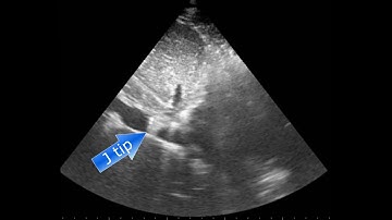 Video 2 Cianchi G et al, Echo-Guided Insertion of a Dual-Lumen Cannula VV ECMO