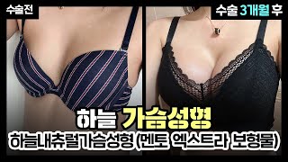 [부산 가슴성형] 가슴 수술 후 라인이 예술이네? 하늘 내츄럴 가슴성형(멘토 엑스트라 스무스 보형물) 3개월간의 변화과정? | 부산성형외과