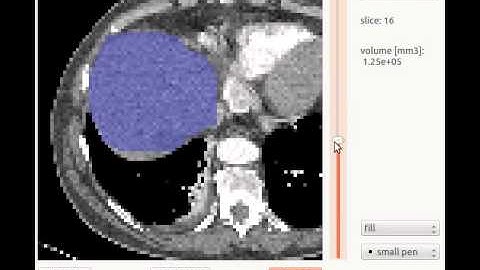 Liver Segmentation