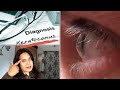 LIFE WITH KERATOCONUS  & ROSE K LENSES (RGP)