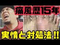 【あなたも注意‼︎】痛風歴約15年の男が語る!痛風の実情と対処法!