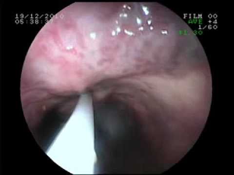 esophageal varices with fundal extensions post-EVL...