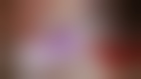 DMEK under PKP Using a modified Jones Tube Glass Injector