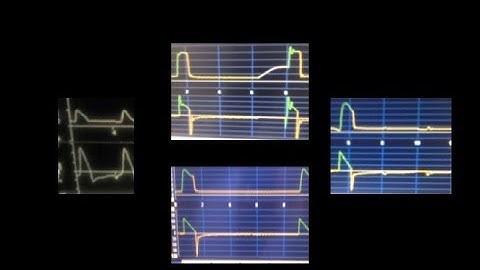 Auto-PEEP and Ineffective Trigger -- BAVLS