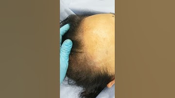 2nd session Hairline Density SMP Female Scalp Micropigmentation by El Truchan