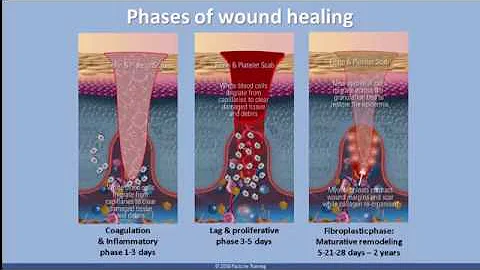 Understanding Scar Tissue