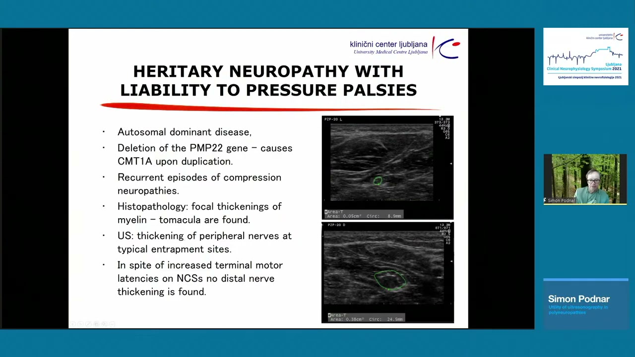 Simon Podnar: Utility of ultrasonography in polyneuropathies