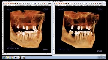 Invivo™ 5 Training Series: Volume Render Tab -  Scatter Reduction