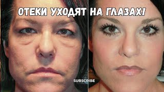 Как убрать отёки и синяки под глазами легко