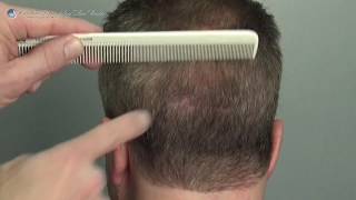 Hair Transplant Result - Dr. Cooley - 2215 Grafts - FUT  hair transplant results