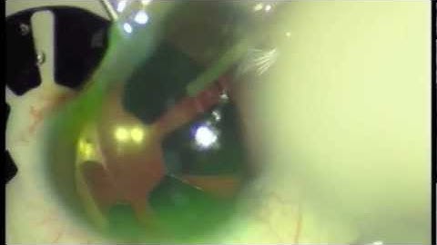 implantation of artificial iris combined with cataract surgery in pediatric age