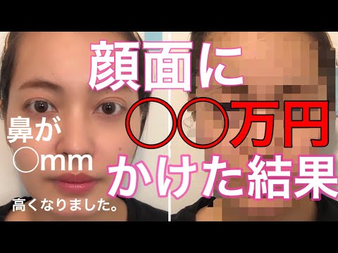 顔面に 万円かけた結果 芸能人と同じ場所に通ったら Youtube 顔面に 万円かけた結果 芸能人と同じ場所に通ったら Youtube