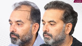 Best Hair Transplant Results from Day 1 to Month 10