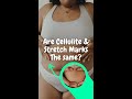 Are cellulite and Stretch Mark The Same