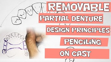Removable Partial Denture Design- Penciling on Cast