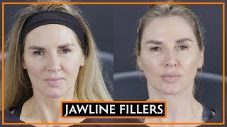 How The Jawline Can Be Defined With Fillers