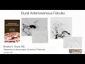 Bradley Gross Discusses Dural Arteriovenous Fistulas