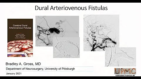Bradley Gross Discusses Dural Arteriovenous Fistulas