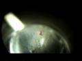 Laser Peripheral Iriditotomy to Prevent Glaucoma Part 2