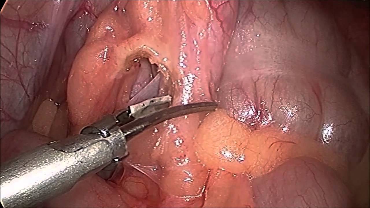 Laparoscopic Appendectomy in Pediatric Patient YouTube