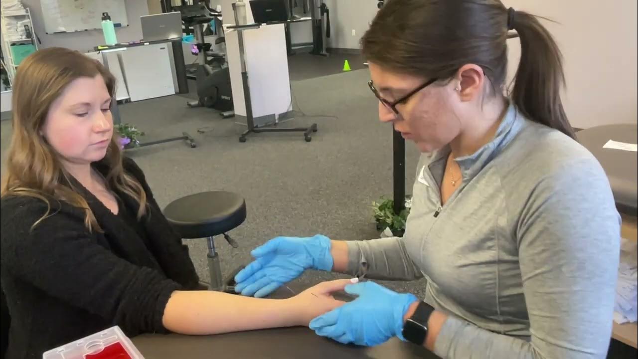 Dry Needling for Carpal Tunnel Syndrome YouTube