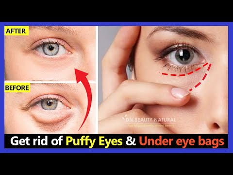 How to Get rid of Puffy Eyes and Under eye bags in 2 weeks. Facial Exercises & Lymphatic Eye Massage