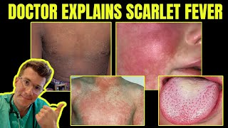 Strep A and Scarlet Fever - King's Medical Centre