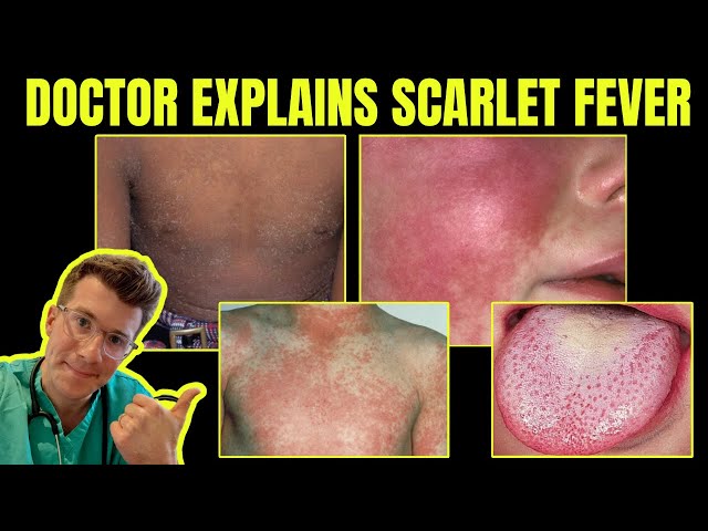 Scarlet fever - Symptoms & causes - Mayo Clinic