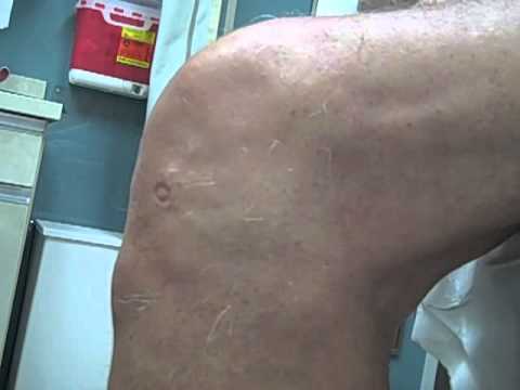 how to give a knee injection flexed position youtube right knee anatomy