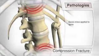 Compression Fracture Pathology